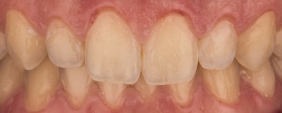 Masking White Spot Lesions with Icon