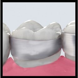 3M Victory Series First Molar Bands, 952-187, Upper, Left, Size 43+, Standard, Contoured, Regular, 1-Pack