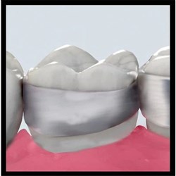 3M Victory Series First Molar Bands, 952-265, Upper, Right, Size 32+, Standard, Contoured, Regular, 1-Pack