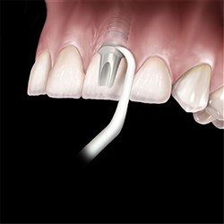 HuFriedyGroup Implacare II Implant Maintenance Starter Kit