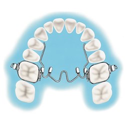 NAOL Nitanium Palatal Expander, 32mm