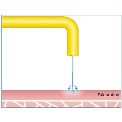 fulguration