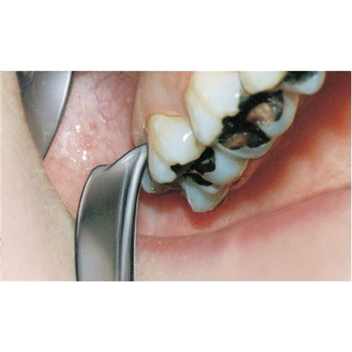 Aesculap Elevator - LUXATING ROSIN - Upper Wisdom Teeth - DL069R - 160mm