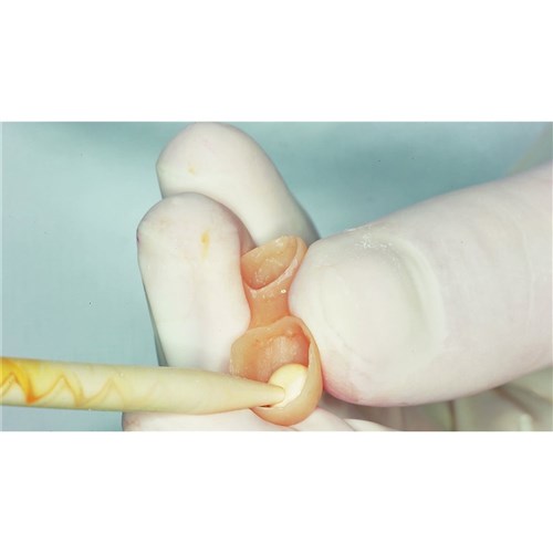 DMG TempoCem - Temporary Luting Cement with Eugenol - 63g Automix Cartridge, 1-Pack and Mixing Tips