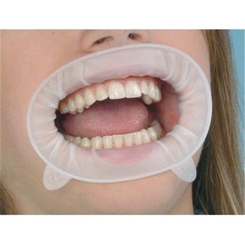 Ivoclar OptraGate Refill - Small, 80-Pack