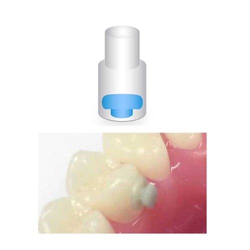 NAOL Mini-Mold Button Bonder, 10-Pack