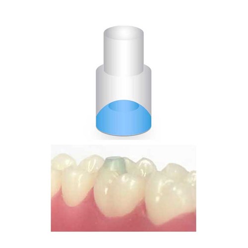NAOL Mini-Mold Post Molar Pads, 10-Pack