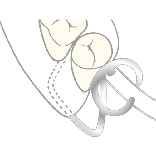 Scheu TK Clasp - 0.9mm, 10-Pack